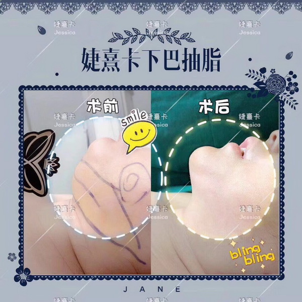 婕熹卡下巴整形-5