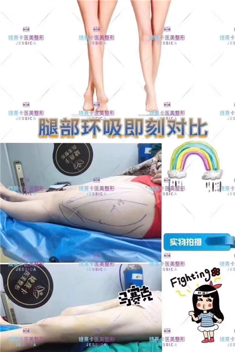 婕熹卡腿部环吸术前术后 