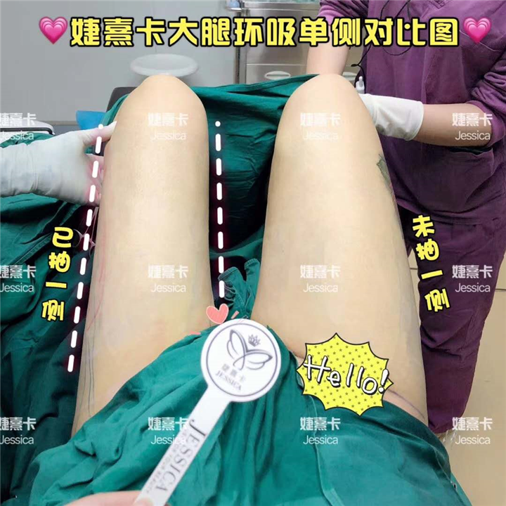 婕熹卡大腿环吸对比 