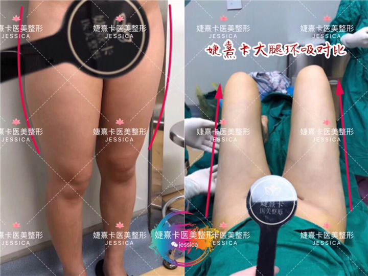 婕熹卡大腿环吸对比 